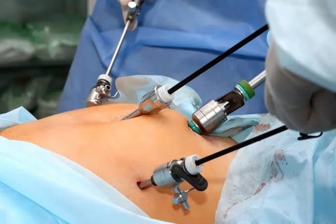 Latest Advances in Laparoscopic Surgery in Islamabad